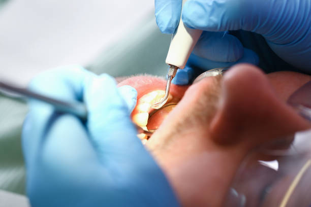 Best Emergency Root Canal Therapy in Minneapolis, KS